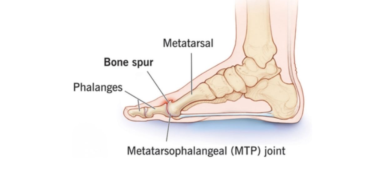 Hallux Rigidus